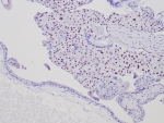 IHC staining of FFPE human complete mole (CM) tissue with p57Kip2 antibody. Strong nuclear staining observed using KIP2/7187 mAb at 2ug/ml. HIER: boil tissue sections in pH 9 10mM Tris with 1mM EDTA for 20 min and allow to cool before testing.