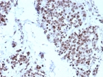 IHC staining of FFPE human bladder tissue with p57Kip2 antibody. Strong nuclear staining using KIP2/8572 mAb at 2ug/ml. HIER: boil tissue sections in pH 9 10mM Tris with 1mM EDTA for 20 min and allow to cool before testing.