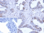 IHC staining of FFPE human prostate carcinoma tissue with BATF2 antibody (clone PCRP-BATF2-2B9). Inset: PBS used in place of primary Ab (secondary Ab negative control). HIER: boil tissue sections in pH 9 10mM Tris with 1mM EDTA for 20 min and allow to cool before testing.