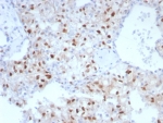 IHC staining of FFPE human renal cell carcinoma tissue with Cyclin D1 antibody (clone CCND1/7868). HIER: boil tissue sections in pH 9 10mM Tris with 1mM EDTA for 20 min and allow to cool before testing.