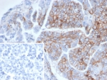 IHC staining of FFPE human ovarian cancer tissue with CD56 antibody (clone NCAM/6715). Inset: PBS used in place of primary Ab (secondary Ab negative control). HIER: boil tissue sections in pH 9 10mM Tris with 1mM EDTA for 20 min and allow to cool before testing.