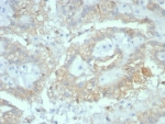 IHC staining of FFPE human renal cell carcinoma tissue with Crystallin Alpha B antibody (clone CRYAB/7918). HIER: boil tissue sections in pH 9 10mM Tris with 1mM EDTA for 20 min and allow to cool before testing.