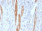 IHC staining of FFPE human colon tissue with NCAM antibody (clone rNCAM1/8580). HIER: boil tissue sections in pH 9 10mM Tris with 1mM EDTA for 20 min and allow to cool before testing.