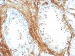 IHC staining of FFPE human prostate carcinoma tissue with recombinant Transgelin antibody (clone rTAGLN/8975). HIER: boil tissue sections in pH 9 10mM Tris with 1mM EDTA for 20 min and allow to cool before testing.
