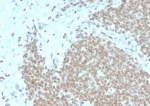IHC staining of FFPE human Ewing's Sarcoma (EWS) tissue with FLI1 antibody (clone FLI1/4371R). HIER: boil tissue sections in pH 9 10mM Tris with 1mM EDTA for 20 min and allow to cool before testing.