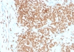 IHC staining of FFPE human Ewing's Sarcoma (EWS) with FLI1 antibody (clone FLI1/4371R). HIER: boil tissue sections in pH 9 10mM Tris with 1mM EDTA for 20 min and allow to cool before testing.