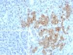 IHC staining of FFPE human pancreas tissue with NSE antibody (clone ENO/8253R). Inset: PBS used in place of primary Ab (secondary Ab negative control). HIER: boil tissue sections in pH 9 10mM Tris with 1mM EDTA for 20 min and allow to cool before testing.
