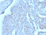 IHC staining of FFPE human bladder carcinoma with Y-box-binding protein 3 antibody (clone PCRP-YBX3-2D12). HIER: boil tissue sections in pH 9 10mM Tris with 1mM EDTA for 20 min and allow to cool before testing.