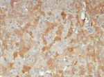 IHC staining of FFPE human hepatocellular carcinoma tissue with Alpha-2M antibody (clone A2M/6556). HIER: boil tissue sections in pH 9 10mM Tris with 1mM EDTA for 20 min and allow to cool before testing.