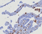 IHC staining of FFPE human ovarian carcinoma tissue with CD163 antibody (clone M130/8361R). HIER: boil tissue sections in pH 9 10mM Tris with 1mM EDTA for 20 min and allow to cool before testing.