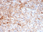 IHC staining of FFPE human hepatocellular carcinoma tissue with Alpha-2-Macroglobulin antibody (clone A2M/4849). HIER: boil tissue sections in pH 9 10mM Tris with 1mM EDTA for 20 min and allow to cool before testing.
