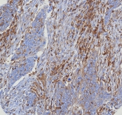 IHC staining of FFPE human bladder cancer pT24 with recombinant CD4 antibody (clone CD4/8203R) at 2ug/ml. HIER: boil tissue sections in pH 9 10mM Tris with 1mM EDTA for 20 min and allow to cool before testing.