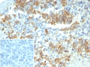 IHC staining of FFPE human ovarian carcinoma tissue with Cytokeratin-7 antibody (clone KRT7/3733). Inset: PBS used in place of primary Ab (secondary Ab negative control). HIER: boil tissue sections in pH 9 10mM Tris with 1mM EDTA for 20 min and allow to cool before testing.