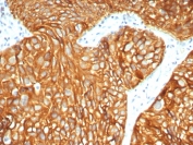 IHC staining of FFPE human bladder carcinoma with Cytokeratin-7 antibody (clone KRT7/3733). HIER: boil tissue sections in pH 9 10mM Tris with 1mM EDTA for 20 min and allow to cool before testing.