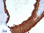 IHC staining of FFPE human prostate carcinoma tissue with recombinant KRT18 antibody (clone rKRT18/7299). HIER: boil tissue sections in pH 9 10mM Tris with 1mM EDTA for 20 min and allow to cool before testing.