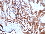 IHC staining of FFPE human prostate carcinoma tissue with recombinant KRT7 antibody (clone rKRT7/8763). HIER: boil tissue sections in pH 9 10mM Tris with 1mM EDTA for 20 min and allow to cool before testing.