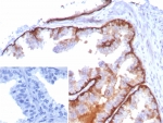 IHC staining of FFPE human tonsil tissue with Cytokeratin 5 antibody (clone KRT5/8814R). Inset: PBS used in place of primary Ab (secondary Ab negative control). HIER: boil tissue sections in pH 9 10mM Tris with 1mM EDTA for 20 min and allow to cool before testing.