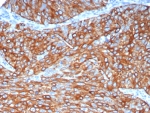 IHC staining of FFPE human lung adenocarcinoma tissue with Cytokeratin 6A antibody (clone KRT6/8120R). HIER: boil tissue sections in pH 9 10mM Tris with 1mM EDTA for 20 min and allow to cool before testing.