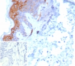 IHC staining of FFPE human skin tissue with KRT6 antibody (clone KRT6/8267R). Inset: PBS used in place of primary Ab (secondary Ab negative control). HIER: boil tissue sections in pH 9 10mM Tris with 1mM EDTA for 20 min and allow to cool before testing.