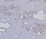 IHC staining of FFPE human prostate carcinoma tissue with Cytokeratin 5/6 antibody (clone KRT5.6/8275R). HIER: boil tissue sections in pH 9 10mM Tris with 1mM EDTA for 20 min and allow to cool before testing.