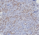 IHC staining of FFPE human mammary cancer tissue with recombinant CDK4 antibody (clone CDK4/8351R). HIER: boil tissue sections in pH 9 10mM Tris with 1mM EDTA for 20 min and allow to cool before testing.