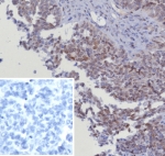 IHC staining of FFPE human serous ovarian cancer tissue with recombinant CDK4 antibody (clone CDK4/8351R). Inset: PBS used in place of primary Ab (secondary Ab negative control). HIER: boil tissue sections in pH 9 10mM Tris with 1mM EDTA for 20 min and allow to cool before testing.