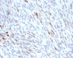 IHC staining of FFPE human liposarcoma tissue with MDM2 antibody (clone MDM2/7190R). HIER: boil tissue sections in pH 9 10mM Tris with 1mM EDTA for 20 min and allow to cool before testing.