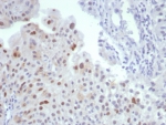 IHC staining of FFPE human bladder tissue with MDM2 antibody (clone MDM2/7190R). HIER: boil tissue sections in pH 9 10mM Tris with 1mM EDTA for 20 min and allow to cool before testing.