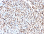 IHC staining of FFPE human liposarcoma tissue with CDK4 antibody (clone CDK4/7987R). HIER: boil tissue sections in pH 9 10mM Tris with 1mM EDTA for 20 min and allow to cool before testing.