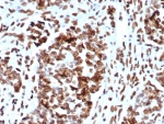 IHC staining of FFPE human ovarian cancer tissue with MDM2 antibody (clone MDM2/7942). HIER: boil tissue sections in pH 9 10mM Tris with 1mM EDTA for 20 min and allow to cool before testing.