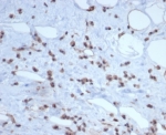 IHC staining of FFPE human liposarcoma tissue with MDM2 antibody (clone MDM2/7189R). HIER: boil tissue sections in pH 9 10mM Tris with 1mM EDTA for 20 min and allow to cool before testing.