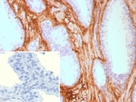 IHC staining of FFPE human prostate carcinoma tissue with recombinant DCN antibody (clone rDCN/9075). Inset: PBS used in place of primary Ab (secondary Ab negative control). HIER: boil tissue sections in pH 9 10mM Tris with 1mM EDTA for 20 min and allow to cool before testing.