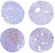 IHC staining of FFPE human (1) mammary carcinoma (2) transverse muscle (3) tonsil and (4) tonsil tissue with CD162 antibody (clone PSGL1/8135R) . HIER: boil tissue sections in pH 9 10mM Tris with 1mM EDTA for 20 min and allow to cool before testing.
