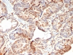 IHC staining of FFPE human colon carcinoma tissue with recombinant Retinoblastoma antibody (clone rRB1/8060). HIER: boil tissue sections in pH 9 10mM Tris with 1mM EDTA for 20 min and allow to cool before testing.
