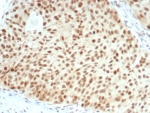 IHC staining of FFPE human bladder carcinoma with recombinant Retinoblastoma antibody (clone RB1/7080R). HIER: boil tissue sections in pH 9 10mM Tris with 1mM EDTA for 20 min and allow to cool before testing.
