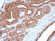 IHC staining of FFPE human prostate tissue with CD107a / LAMP1 antibody (clone LAMP1/7458). HIER: boil tissue sections in pH 9 10mM Tris with 1mM EDTA for 20 min and allow to cool before testing.