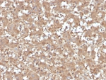 IHC staining of FFPE human liver tissue with AAT antibody (clone AAT/4615). HIER: boil tissue sections in pH 9 10mM Tris with 1mM EDTA for 20 min and allow to cool before testing.
