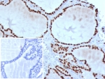 IHC staining of FFPE human thyroid tissue with TTF-1 antibody (clone TTF1/8427). Inset: PBS used in place of primary Ab (secondary Ab negative control). HIER: boil tissue sections in pH 9 10mM Tris with 1mM EDTA for 20 min and allow to cool before testing.
