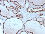 IHC staining of FFPE human thyroid tissue with TTF-1 antibody (clone TTF1/8427). HIER: boil tissue sections in pH 9 10mM Tris with 1mM EDTA for 20 min and allow to cool before testing.