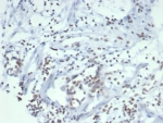 IHC staining of FFPE human ovarian carcinoma tissue with Estrogen Sulfotransferase antibody (clone SULT1E1/7124). HIER: boil tissue sections in pH 9 10mM Tris with 1mM EDTA for 20 min and allow to cool before testing.