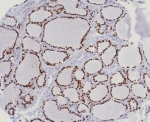 IHC staining of FFPE human lung adenocarcinoma tissue with NKX2.1 antibody (clone TTF1/8123R). HIER: boil tissue sections in pH 9 10mM Tris with 1mM EDTA for 20 min and allow to cool before testing.