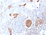 IHC staining of FFPE human breast carcinoma tissue with HIF1A antibody (clone HIF1A/3248). Inset: PBS used in place of primary Ab (secondary Ab negative control). HIER: boil tissue sections in pH 9 10mM Tris with 1mM EDTA for 20 min and allow to cool before testing.