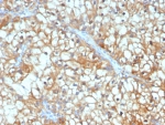 IHC staining of FFPE human renal cell carcinoma tissue with TGF beta 3 antibody (clone TGFB3/4801). HIER: boil tissue sections in pH 9 10mM Tris with 1mM EDTA for 20 min and allow to cool before testing.