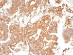 IHC staining of FFPE human prostate tissue with SERPINA1 antibody (clone AAT/4613). HIER: boil tissue sections in pH 9 10mM Tris with 1mM EDTA for 20 min and allow to cool before testing.