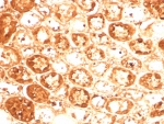 IHC staining of FFPE human kidney tissue with Alpha-1-Antitrypsin antibody (clone AAT/8909). HIER: boil tissue sections in pH 9 10mM Tris with 1mM EDTA for 20 min and allow to cool before testing.