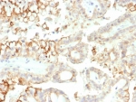 IHC staining of FFPE human kidney carcinoma tissue with B7-H3 antibody (clone B7H3/4313) at 2ug/ml. HIER: boil tissue sections in pH 9 10mM Tris with 1mM EDTA for 20 min and allow to cool before testing.