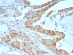 IHC staining of FFPE human colon cancer tissue with ANXA2 antibody (clone 3D5/4). HIER: boil tissue sections in pH 9 10mM Tris with 1mM EDTA for 20 min and allow to cool before testing.