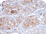 IHC staining of FFPE human lung cancer tissue with B7-H3 antibody (clone B7H3/4479) at 2ug/ml. HIER: boil tissue sections in pH 9 10mM Tris with 1mM EDTA for 20 min and allow to cool before testing.