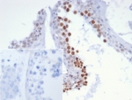 IHC staining of FFPE human testis tissue with NUT family member 1 antibody (clone SNUPN/7363R). Inset: PBS used in place of primary Ab (secondary Ab negative control). HIER: boil tissue sections in pH 9 10mM Tris with 1mM EDTA for 20 min and allow to cool before testing.