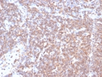 IHC staining of FFPE human lymph node tissue with Polo like kinase 1 antibody (clone PLK1/7122). HIER: boil tissue sections in pH 9 10mM Tris with 1mM EDTA for 20 min and allow to cool before testing.